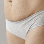 HIFU ABDOMEN