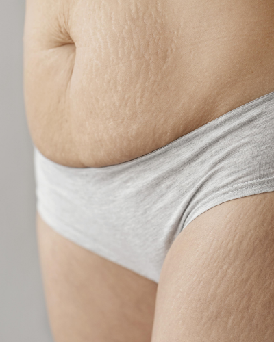 Hifu abdomen