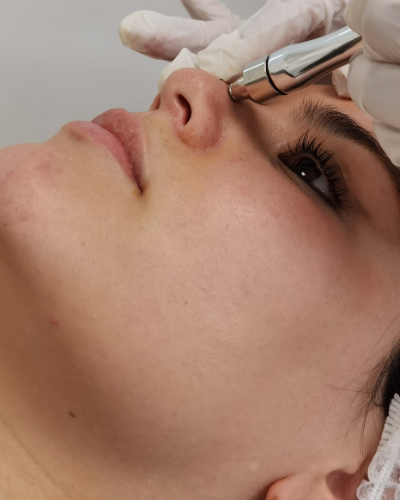 Limpieza facial con microdermoabrasión