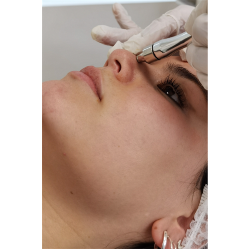 Limpieza facial con microdermoabrasión