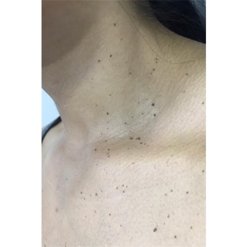 PROMOCIONES BIOZELLEN Eliminacion Acrocordones