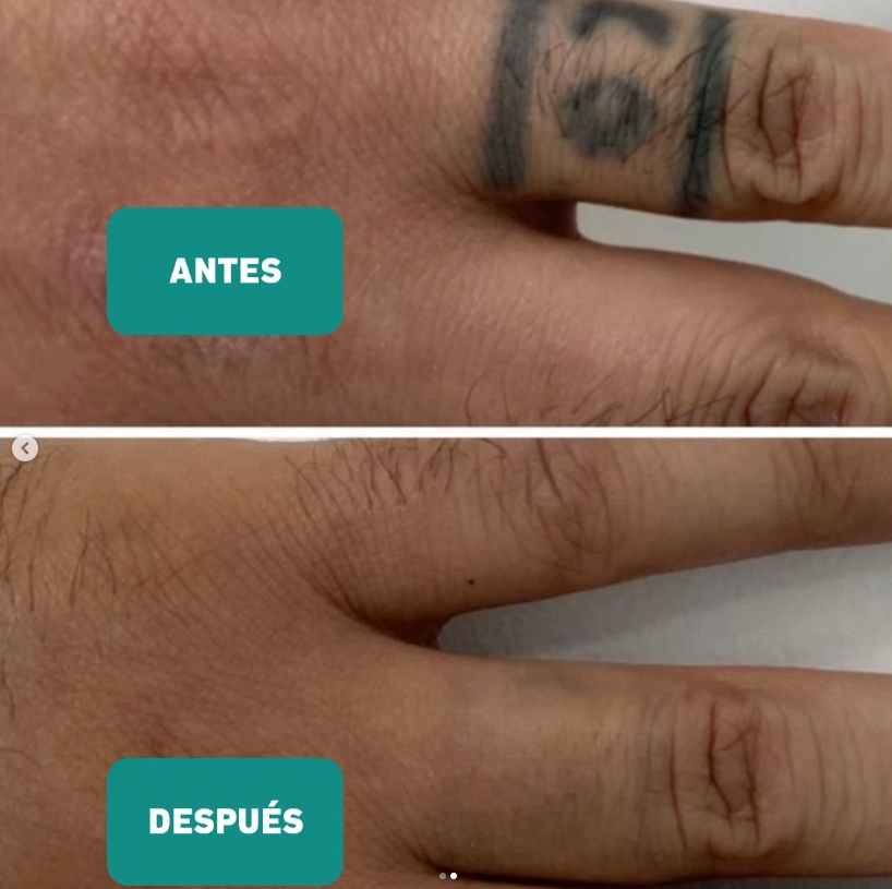 borrado de tatuaje a y d borrado de tatuaje a y d
